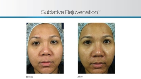 Flawless Laser Spa - Wrinkle Reduction Ogden Utah